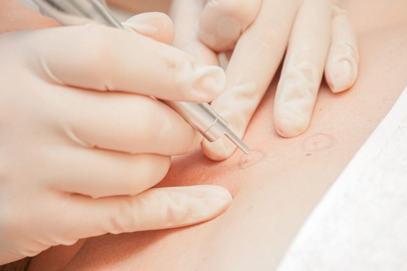 ODSTRÁNENIE KOŽNÝCH VÝRASTKOV